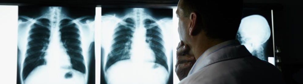 Everything You Need To Know About Lung Cancer